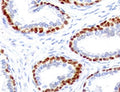 Immunohistochemistry analysis of p63 expression. Recombinant TP63 antibody (clone TMPR63-1R) staining was performed on formalin-fixed, paraffin-embedded human prostate cancer tissue, showing nuclear DAB-positive staining in basal-type epithelial cells lining glandular structures, with surrounding stromal cells largely negative and hematoxylin counterstaining.