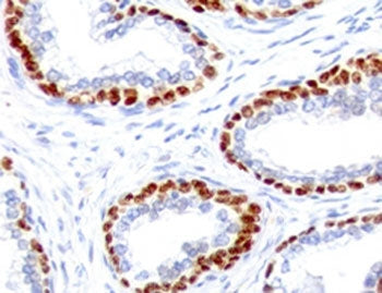 Immunohistochemistry analysis of p63 expression. Recombinant TP63 antibody (clone TMPR63-1R) staining was performed on formalin-fixed, paraffin-embedded human prostate cancer tissue, showing nuclear DAB-positive staining in basal-type epithelial cells lining glandular structures, with surrounding stromal cells largely negative and hematoxylin counterstaining.