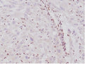 IHC staining of FFPE human epithelioid sarcoma with Integrase interactor 1 antibody (clone SMARCB1/4587R). HIER: boil tissue sections in pH 9 10mM Tris with 1mM EDTA for 20 min and allow to cool before testing.
