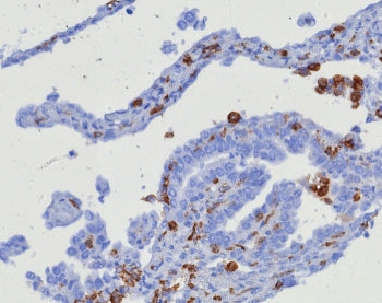 IHC staining of FFPE human ovarian carcinoma tissue with CD163 antibody (clone M130/8361R). HIER: boil tissue sections in pH 9 10mM Tris with 1mM EDTA for 20 min and allow to cool before testing.