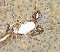 Annexin V antibody IHC analysis in formalin fixed and paraffin embedded human hepatocarcinoma.