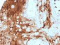 IHC staining of FFPE human breast cancer tissue with S100A9 antibody (clone S100A9/1075). HIER: boil tissue sections in pH 9 10mM Tris with 1mM EDTA for 20 min and allow to cool before testing.