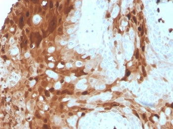 IHC staining of FFPE human breast cancer tissue with S100A9 antibody (clone S100A9/1075). HIER: boil tissue sections in pH 9 10mM Tris with 1mM EDTA for 20 min and allow to cool before testing.