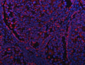 Immunofluorescent staining of FFPE human lung cancer tissue with GRIM19 antibody (red) and DAPI nuclear stain (blue). HIER: steam section in pH8 EDTA buffer for 20 min.