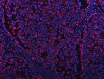 Immunofluorescent staining of FFPE human lung cancer tissue with GRIM19 antibody (red) and DAPI nuclear stain (blue). HIER: steam section in pH8 EDTA buffer for 20 min.