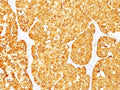 IHC: Formalin-fixed, paraffin-embedded human melanoma stained with MART-1 / Melan-A antibody (M2-7C10 + M2-9E3).