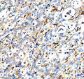Immunohistochemical staining of DOCK8 using anti-DOCK8 antibody. DOCK8 was detected in a paraffin-embedded section of human pancreas cancer tissue. Heat mediated antigen retrieval was performed in EDTA buffer (pH 8.0, epitope retrieval solution). The tissue section was blocked with 10% goat serum. The tissue section was then incubated with 2 ug/ml rabbit anti-DOCK8 antibody overnight at 4oC. Peroxidase Conjugated Goat Anti-rabbit IgG was used as secondary antibody and incubated for 30 min at 37oC.
