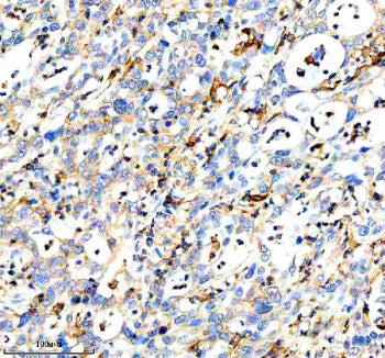 Immunohistochemical staining of DOCK8 using anti-DOCK8 antibody. DOCK8 was detected in a paraffin-embedded section of human pancreas cancer tissue. Heat mediated antigen retrieval was performed in EDTA buffer (pH 8.0, epitope retrieval solution). The tissue section was blocked with 10% goat serum. The tissue section was then incubated with 2 ug/ml rabbit anti-DOCK8 antibody overnight at 4oC. Peroxidase Conjugated Goat Anti-rabbit IgG was used as secondary antibody and incubated for 30 min at 37oC.