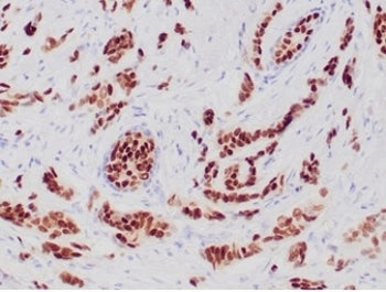 IHC staining of FFPE human breast carcinoma tissue with recombinant Progesterone Receptor antibody (clone PGR/6854R). HIER: boil tissue sections in pH 9 10mM Tris with 1mM EDTA for 20 min and allow to cool before testing.