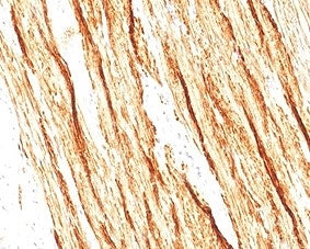 IHC staining of FFPE human colon tissue with recombinant Smoothelin antibody (clone SMTN/2320R). HIER: boil tissue sections in pH6, 10mM citrate buffer, for 20 min and allow to cool before testing.