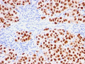IHC testing of FFPE human melanoma with recombinant SOX10 antibody (clone rSOX10/1074). Required HIER: boil tissue sections in 10mM citrate buffer, pH 6, for 10-20 min followed by cooling at RT for 20 min.