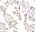 Immunohistochemical staining of MEST using anti-MEST antibody. MEST was detected in a paraffin-embedded section of human thyroid papillary carcinoma tissue. Heat mediated antigen retrieval was performed in EDTA buffer (pH 8.0, epitope retrieval solution). The tissue section was blocked with 10% goat serum. The tissue section was then incubated with 2 ug/ml rabbit anti-MEST antibody overnight at 4oC. Peroxidase Conjugated Goat Anti-rabbit IgG was used as secondary antibody and incubated for 30 min at 37oC.
