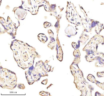 Immunohistochemical staining of MEST using anti-MEST antibody. MEST was detected in a paraffin-embedded section of human thyroid papillary carcinoma tissue. Heat mediated antigen retrieval was performed in EDTA buffer (pH 8.0, epitope retrieval solution). The tissue section was blocked with 10% goat serum. The tissue section was then incubated with 2 ug/ml rabbit anti-MEST antibody overnight at 4oC. Peroxidase Conjugated Goat Anti-rabbit IgG was used as secondary antibody and incubated for 30 min at 37oC.