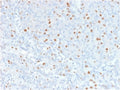 IHC testing of FFPE human bladder carinoma with Annexin A1 antibody (clone 6E4/3). HIER: boil tissue sections in pH6, 10mM citrate buffer, for 10-20 min followed by cooling at RT for 20 min.