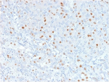 IHC testing of FFPE human bladder carinoma with Annexin A1 antibody (clone 6E4/3). HIER: boil tissue sections in pH6, 10mM citrate buffer, for 10-20 min followed by cooling at RT for 20 min.