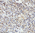 Immunohistochemical staining of STRIP2 using anti-STRIP2 antibody. STRIP2 was detected in a paraffin-embedded section of human breast cancer tissue. Heat mediated antigen retrieval was performed in EDTA buffer (pH 8.0, epitope retrieval solution). The tissue section was blocked with 10% goat serum. The tissue section was then incubated with 2 ug/ml rabbit anti-STRIP2 antibody overnight at 4oC. Peroxidase Conjugated Goat Anti-rabbit IgG was used as secondary antibody and incubated for 30 min at 37oC.