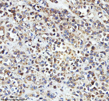 Immunohistochemical staining of STRIP2 using anti-STRIP2 antibody. STRIP2 was detected in a paraffin-embedded section of human breast cancer tissue. Heat mediated antigen retrieval was performed in EDTA buffer (pH 8.0, epitope retrieval solution). The tissue section was blocked with 10% goat serum. The tissue section was then incubated with 2 ug/ml rabbit anti-STRIP2 antibody overnight at 4oC. Peroxidase Conjugated Goat Anti-rabbit IgG was used as secondary antibody and incubated for 30 min at 37oC.