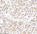 Immunohistochemical staining of CLTB using anti-CLTB antibody. CLTB was detected in a paraffin-embedded section of human endometrial cancer tissue. Heat mediated antigen retrieval was performed in EDTA buffer (pH 8.0, epitope retrieval solution). The tissue section was blocked with 10% goat serum. The tissue section was then incubated with 2 ug/ml rabbit anti-CLTB antibody overnight at 4oC. Peroxidase Conjugated Goat Anti-rabbit IgG was used as secondary antibody and incubated for 30 min at 37oC.