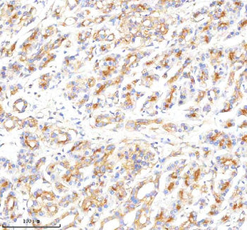 Immunohistochemical staining of CLTB using anti-CLTB antibody. CLTB was detected in a paraffin-embedded section of human endometrial cancer tissue. Heat mediated antigen retrieval was performed in EDTA buffer (pH 8.0, epitope retrieval solution). The tissue section was blocked with 10% goat serum. The tissue section was then incubated with 2 ug/ml rabbit anti-CLTB antibody overnight at 4oC. Peroxidase Conjugated Goat Anti-rabbit IgG was used as secondary antibody and incubated for 30 min at 37oC.