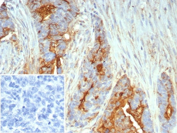 IHC staining of FFPE human ovarian cancer tissue with Mucin 1 antibody (clone MUC1/7797R). Inset: PBS used in place of primary Ab (secondary Ab negative control). HIER: boil tissue sections in pH 9 10mM Tris with 1mM EDTA for 20 min and allow to cool before testing.