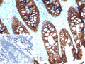 IHC staining of FFPE human colon tissue with CDH17 antibody (clone CDH17/8515R). Inset: PBS used in place of primary Ab (secondary Ab negative control). HIER: boil tissue sections in pH 9 10mM Tris with 1mM EDTA for 20 min and allow to cool before testing.