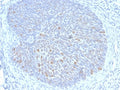 IHC staining of FFPE human cervix with HPV16 E1/E4 antibody. HIER: boil tissue sections in pH 9 10mM Tris with 1mM EDTA for 20 min and allow to cool before testing.