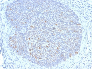 IHC staining of FFPE human cervix with HPV16 E1/E4 antibody. HIER: boil tissue sections in pH 9 10mM Tris with 1mM EDTA for 20 min and allow to cool before testing.