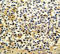 IHC analysis of FFPE human kidney carcinoma with DCXR antibody
