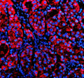Immunofluorescent staining of P4HA1 using anti-P4HA1 antibody (red). P4HA1 was detected in a paraffin-embedded section of human liver cancer tissue. Heat mediated antigen retrieval was performed in EDTA buffer (pH 8.0, epitope retrieval solution). The tissue section was blocked with 10% goat serum. The tissue section was then incubated with 5 ug/ml rabbit anti-P4HA1 antibody overnight at 4oC.