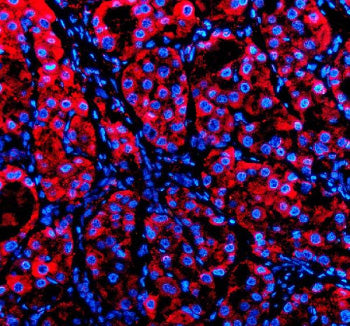 Immunofluorescent staining of P4HA1 using anti-P4HA1 antibody (red). P4HA1 was detected in a paraffin-embedded section of human liver cancer tissue. Heat mediated antigen retrieval was performed in EDTA buffer (pH 8.0, epitope retrieval solution). The tissue section was blocked with 10% goat serum. The tissue section was then incubated with 5 ug/ml rabbit anti-P4HA1 antibody overnight at 4oC.