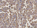 IHC staining of FFPE human lung cancer tissue with NDUFA4 antibody. HIER: boil tissue sections in pH8 EDTA for 20 min and allow to cool before testing.