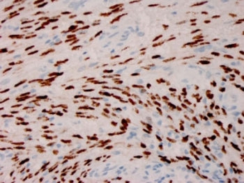 IHC staining of FFPE Kaposiâ€™s sarcoma with Herpes Virus 8 antibody (clone HHV8/3606). HIER: boil tissue sections in pH 9 10mM Tris with 1mM EDTA for 20 min and allow to cool before testing.