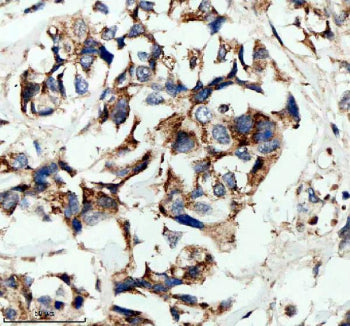 Immunofluorescent staining of HPGD using anti-HPGD antibody (red). HPGD was detected in a paraffin-embedded section of human breast cancer tissue. Heat mediated antigen retrieval was performed in EDTA buffer (pH 8.0, epitope retrieval solution). The tissue section was blocked with 10% goat serum. The tissue section was then incubated with 5 ug/ml rabbit anti-HPGD antibody overnight at 4oC. Cy3 Conjugated Goat Anti-Rabbit IgG was used as secondary antibody at 1:500 dilution and incubated for 30 min at 37oC.