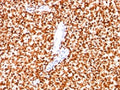 IHC: Formalin-fixed paraffin-embedded human Ewing's sarcoma stained with NKX2.2 antibody (clone SPM564).