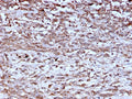 IHC staining of FFPE human hepatocellular carcinoma with Cathepsin K antibody (clone CTSK/2793). HIER: boil tissue sections in pH 9 10mM Tris with 1mM EDTA for 10-20 min and allow to cool before testing.