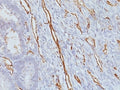 IHC analysis of formalin-fixed, paraffin-embedded human colon carcinoma stained with CD31 antibody (clone JC/70A).