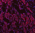 Immunofluorescent staining of FFPE human breast cancer tissue with NDUFB7 antibody (red) and DAPI nuclear stain (blue). HIER: steam section in pH6 citrate buffer for 20 min.