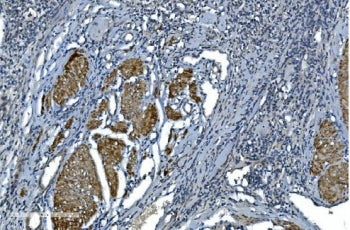 IHC staining of FFPE human bladder cancer with ACTA1 antibody. HIER: boil tissue sections in pH8 EDTA for 20 min and allow to cool before testing.