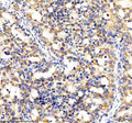 Immunohistochemical staining of CYP7B1 using anti-CYP7B1 antibody. CYP7B1 was detected in a paraffin-embedded section of human breast cancer tissue. Heat mediated antigen retrieval was performed in EDTA buffer (pH 8.0, epitope retrieval solution). The tissue section was blocked with 10% goat serum. The tissue section was then incubated with 2 ug/ml rabbit anti-CYP7B1 antibody overnight at 4oC. Peroxidase Conjugated Goat Anti-rabbit IgG was used as secondary antibody and incubated for 30 min at 37oC.