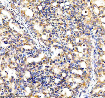 Immunohistochemical staining of CYP7B1 using anti-CYP7B1 antibody. CYP7B1 was detected in a paraffin-embedded section of human breast cancer tissue. Heat mediated antigen retrieval was performed in EDTA buffer (pH 8.0, epitope retrieval solution). The tissue section was blocked with 10% goat serum. The tissue section was then incubated with 2 ug/ml rabbit anti-CYP7B1 antibody overnight at 4oC. Peroxidase Conjugated Goat Anti-rabbit IgG was used as secondary antibody and incubated for 30 min at 37oC.