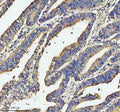 Immunohistochemical staining of SOS1 using anti-SOS1 antibody. SOS1 was detected in a paraffin-embedded section of human colon cancer tissue. Heat mediated antigen retrieval was performed in EDTA buffer (pH 8.0, epitope retrieval solution). The tissue section was blocked with 10% goat serum. The tissue section was then incubated with 2 ug/ml rabbit anti-SOS1 antibody overnight at 4oC. Peroxidase Conjugated Goat Anti-rabbit IgG was used as secondary antibody and incubated for 30 min at 37oC.