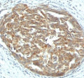 IHC: Formalin-fixed, paraffin-embedded human ovarian carcinoma stained with VEGF antibody (clone SPM225).