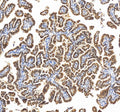 Immunohistochemical staining of RBM17 using anti-RBM17 antibody. RBM17 was detected in a paraffin-embedded section of human ovarian cancer tissue. Heat mediated antigen retrieval was performed in EDTA buffer (pH 8.0, epitope retrieval solution). The tissue section was blocked with 10% goat serum. The tissue section was then incubated with 2 ug/ml rabbit anti-RBM17 antibody overnight at 4oC. Peroxidase Conjugated Goat Anti-rabbit IgG was used as secondary antibody and incubated for 30 min at 37oC.