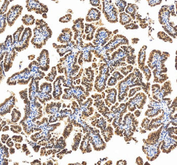 Immunohistochemical staining of RBM17 using anti-RBM17 antibody. RBM17 was detected in a paraffin-embedded section of human ovarian cancer tissue. Heat mediated antigen retrieval was performed in EDTA buffer (pH 8.0, epitope retrieval solution). The tissue section was blocked with 10% goat serum. The tissue section was then incubated with 2 ug/ml rabbit anti-RBM17 antibody overnight at 4oC. Peroxidase Conjugated Goat Anti-rabbit IgG was used as secondary antibody and incubated for 30 min at 37oC.