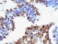 IHC: Formalin-fixed, paraffin-embedded human lung adenocarcinoma stained with Napsin-A antibody (NAPSA/1238 + NAPSA/1239).