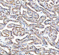 IHC staining of FFPE human thyroid cancer tissue with PRKCH antibody, HRP-secondary and DAB substrate. HIER: boil tissue sections in pH8 EDTA for 20 min and allow to cool before testing.