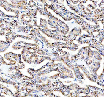 IHC staining of FFPE human thyroid cancer tissue with PRKCH antibody, HRP-secondary and DAB substrate. HIER: boil tissue sections in pH8 EDTA for 20 min and allow to cool before testing.
