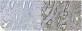 IHC staining of FFPE human gallbladder adenocarcinoma with (right) and without (left) MCM5 antibody. HIER: boil tissue sections in pH8 EDTA for 20 min and allow to cool before testing.
