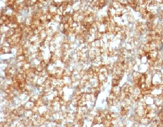 IHC: Formalin-fixed, paraffin-embedded human renal cell carcinoma stained with CD147 antibody (BSG/963).