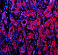 Immunofluorescent staining of NID1 using anti-NID1 antibody (red). NID1 was detected in a paraffin-embedded section of human breast cancer tissue. Heat mediated antigen retrieval was performed in EDTA buffer (pH 8.0, epitope retrieval solution). The tissue section was blocked with 10% goat serum. The tissue section was then incubated with 5 ug/ml rabbit anti-NID1 antibody overnight at 4oC. Cy3 Conjugated Goat Anti-Rabbit IgG was used as secondary antibody at 1:500 dilution and incubated for 30 min at 37oC.